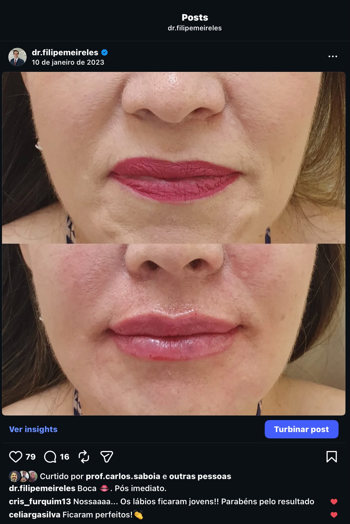 Resultado de preenchimento labial - antes e depois - IHOF Dr. Filipe Meireles