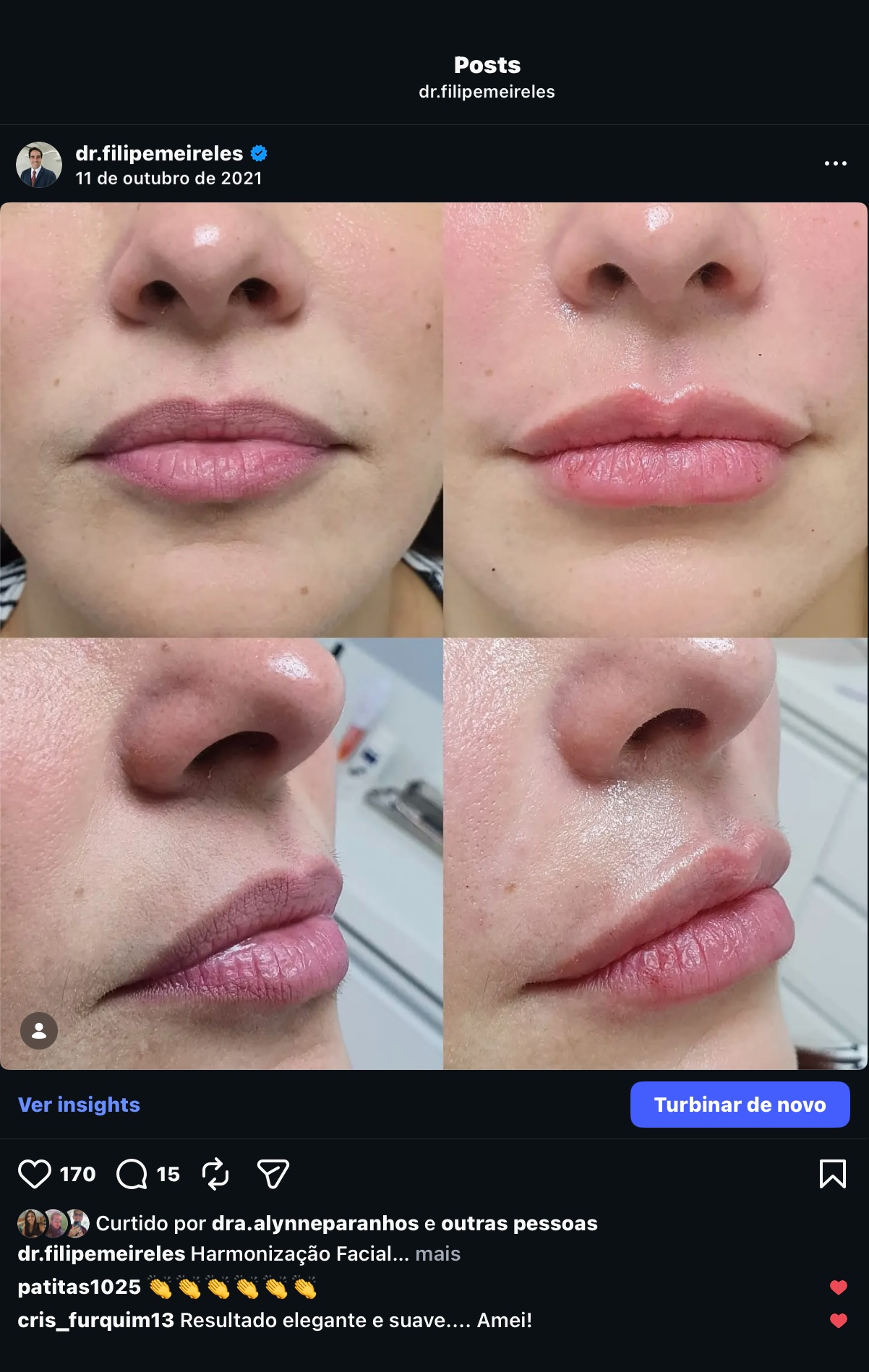 Resultado de preenchimento labial natural - antes e depois - IHOF