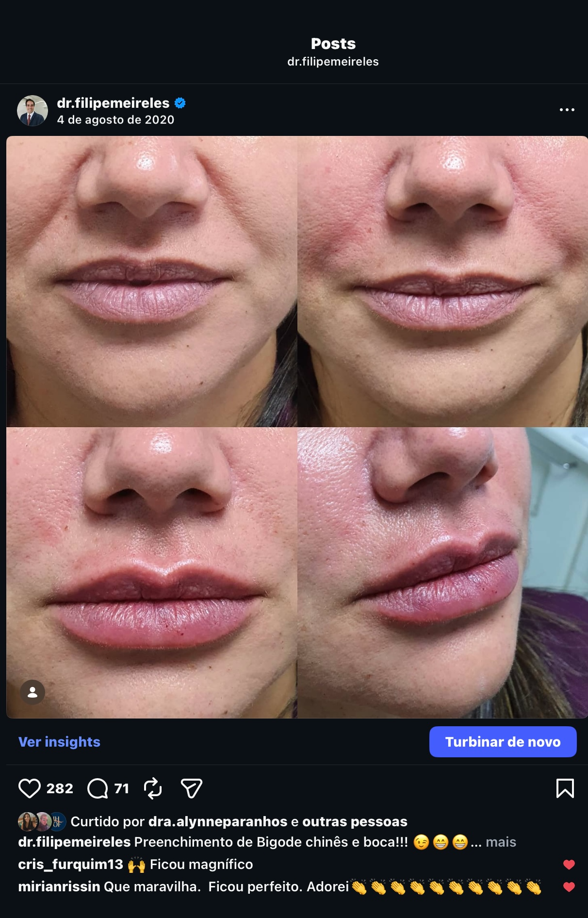 Harmonização labial elegante - antes e depois - Dr. Filipe Meireles